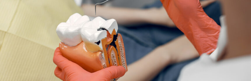 What Is An Abutment In Dentistry